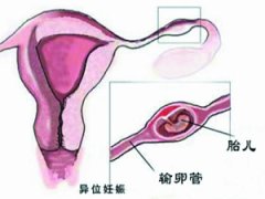 宫外孕治疗合适时间_三大影响治疗因素